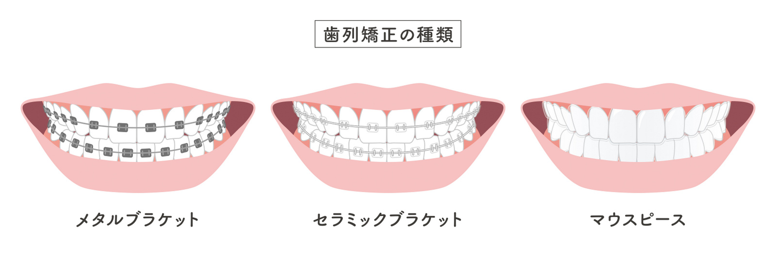 歯列矯正の種類　
